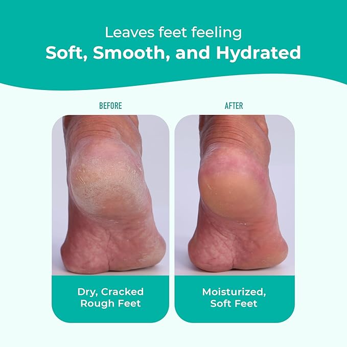RICHENNA EZ Foot Care Cream - Advanced Exfoliating Urea Foot Cream for Dry Cracked Heels and Feet | 14 Natural Ingredients | Repairs, Hydrates and Smoothens Dry Cracked Feet - 100ml /3.38 fl. oz