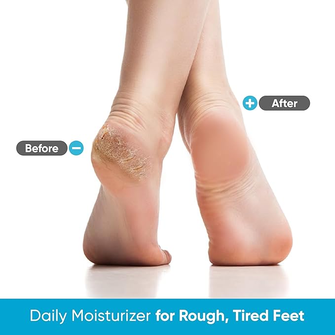 Miratiful Urea Cream 40% w 2% Salicylic Acid (4 oz) | Softens Cracked Heels & Dry Skin Urea Salicylic Acid Cream w/Tea Tree & Coconut Oil | Urea 40 Cream for Callus & Corn Treatment
