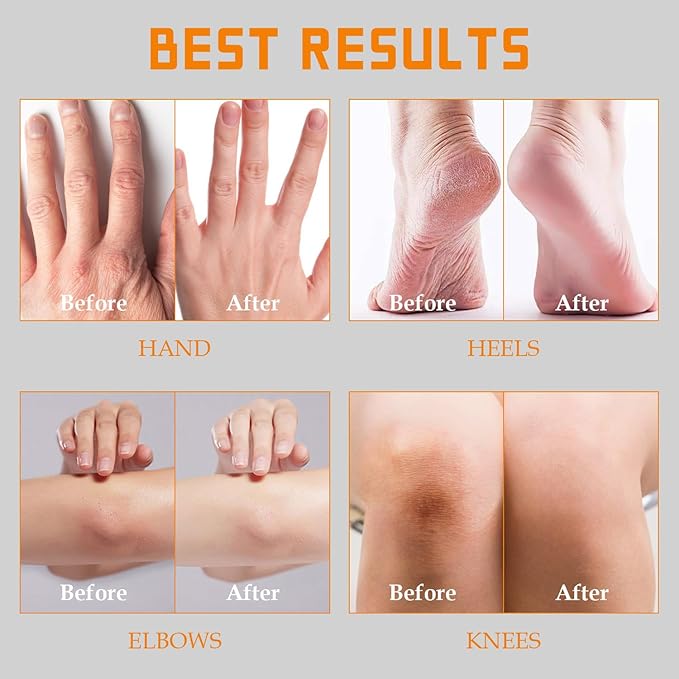 YOUNGYOUNGLOVE Fragrance Free 60% Urea Cream plus 2% Salicylic Acid, for Dry Cracked Hands Knees Feet Heels, Repair Unscented Foot Cream for Dead Skin, Lotion for Moisturizing and Softening 6.76 OZ