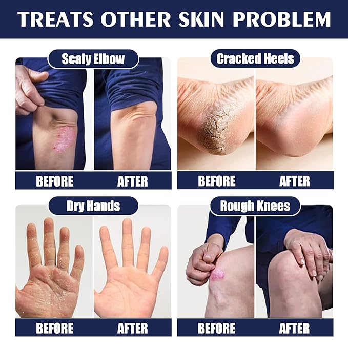 AuroraHyt Ultra-Moisturizing Cream Foot and Hand Cream, 30G, for Dry Chapped Rough Peeling Skin, Cracked Heel Treatment with Beeswax and Shea Butter