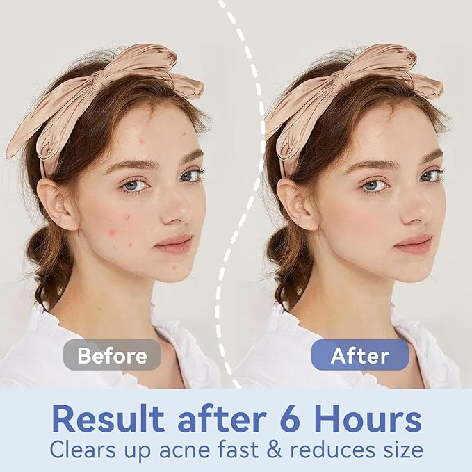 OmaDoto Invisible Pimple Patches for Face - （12mm | 72 Count | 6 Sheets） - Ultra-Thin Hydrocolloid Blemish Cover, Discreet Zit Stickers for Day & Night, Face Patches for Teens and Adults