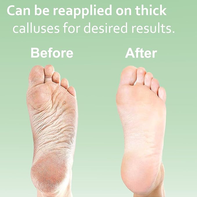 Dr. Entre's Callus Remover Gel & Foot File: Extra Strength Callus Remover for Feet, Foot Callus Remover Care, Pedicure Tools Supplies, Spa Kit, Dead Skin Scrubber, 4 oz